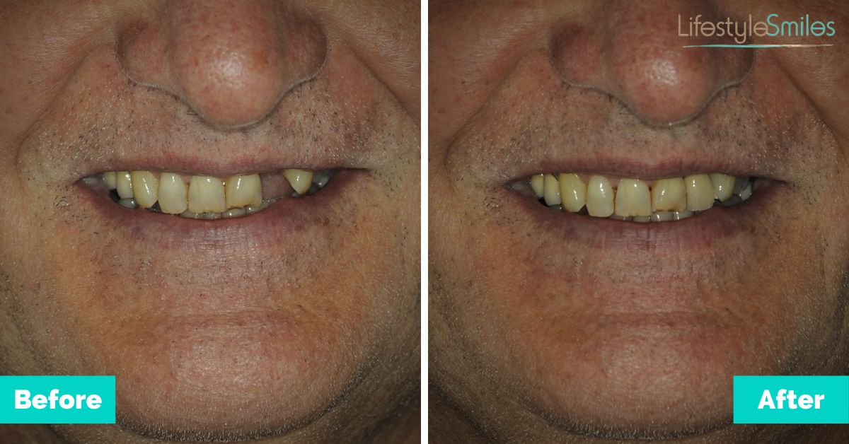 Lifestyle-Smiles-Before-and-After-Ivan2