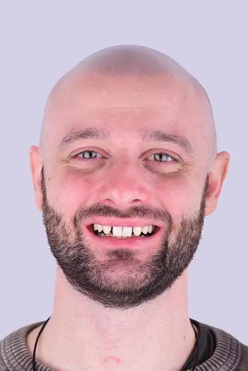 Alessio Composite Veneers After Photo