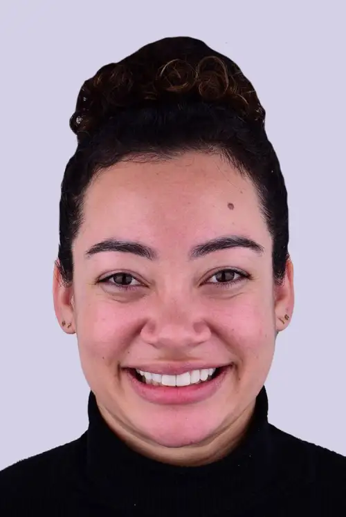Christina Composite Veneers After Photo. Treatment provided by Lifestyle Smiles in Melbourne