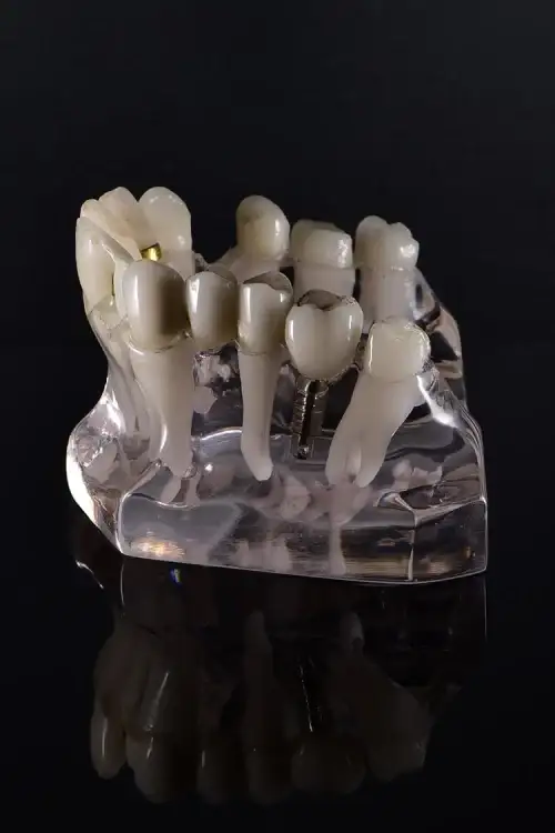 dental-implants-brighton (1) Dental implant procedure at Lifestyle Smiles dental clinic, Brighton
