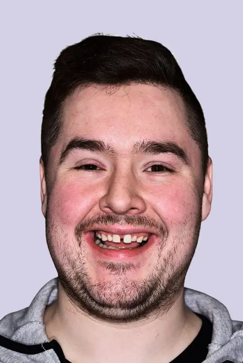 Gary's Invisalign After Photo. Treatment from Lifestyle Smiles in Melbourne
