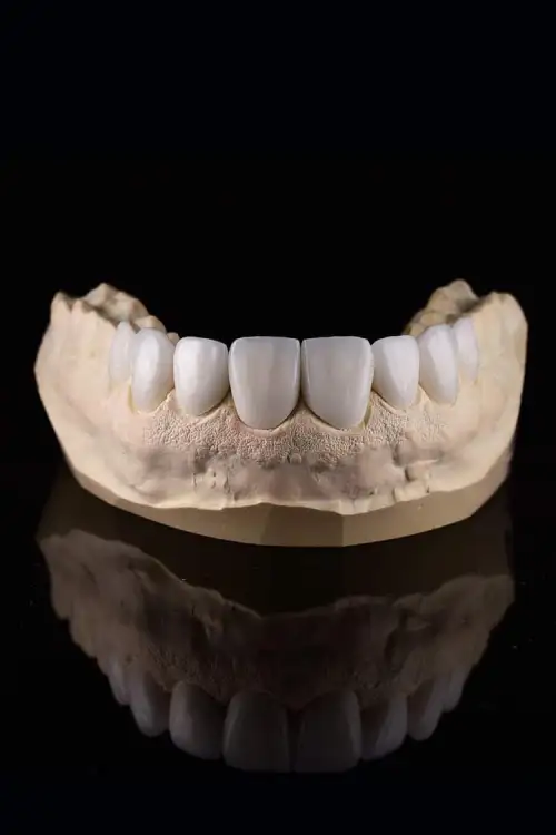 porcelain-veneers-brighton Porcelain veneers before and after — Lifestyle Smiles, Brighton VIC